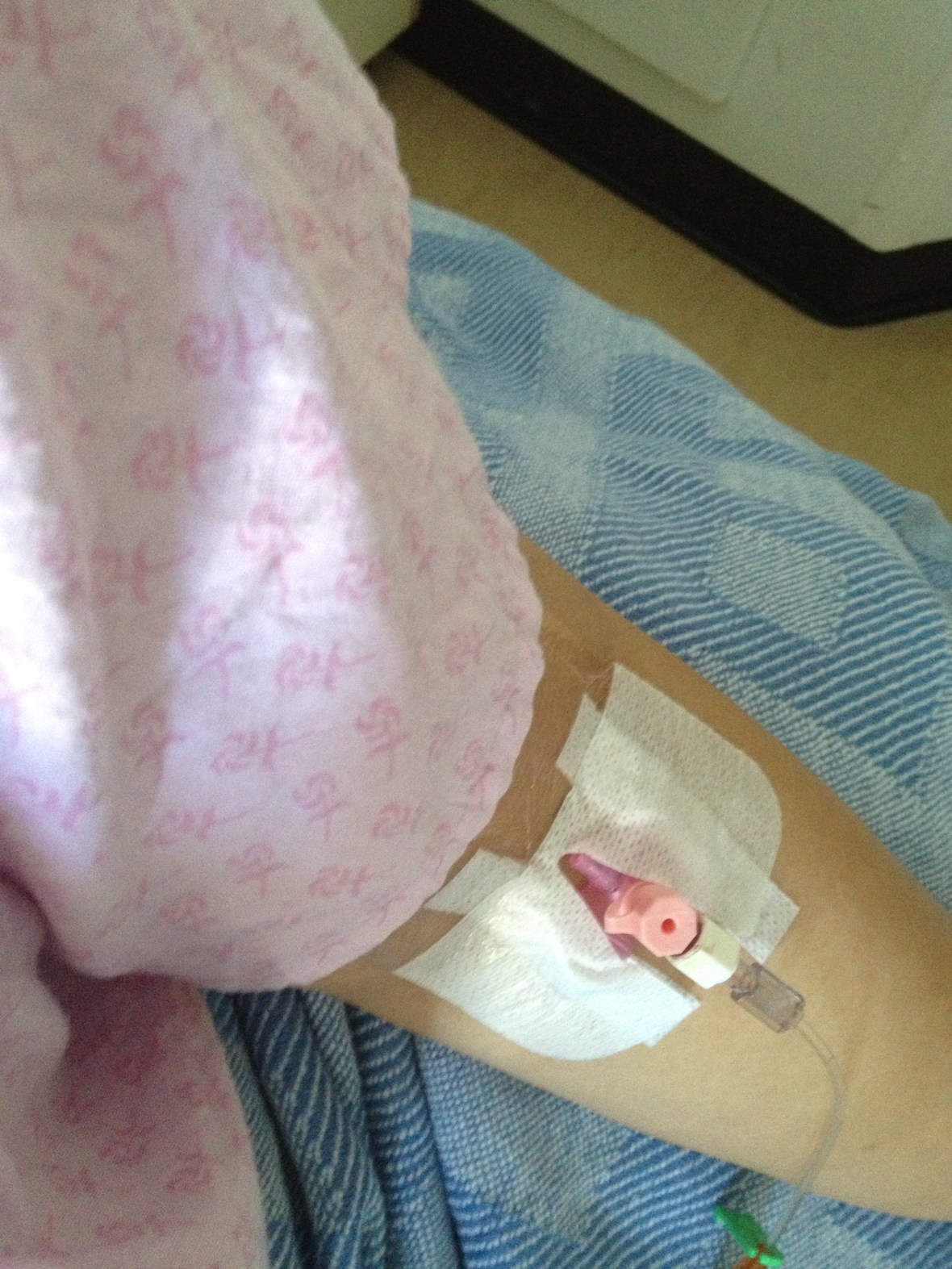 IV cannula