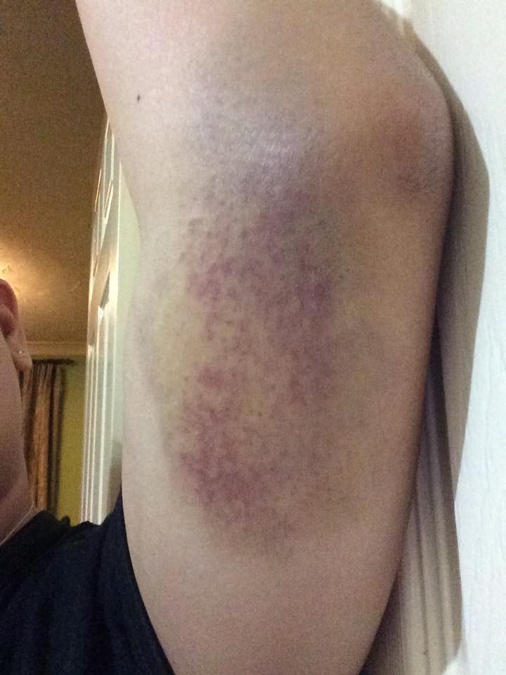 humdinger of a bruise